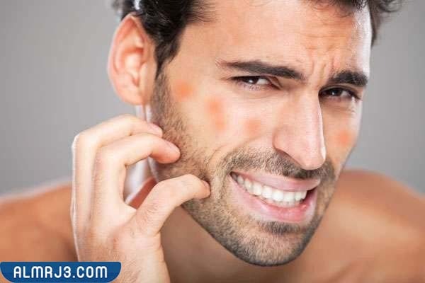 أسباب الإصابة بحكة الوجه واحمراره 