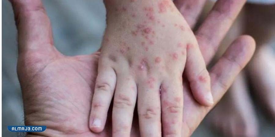 أعراض مرض الجدري