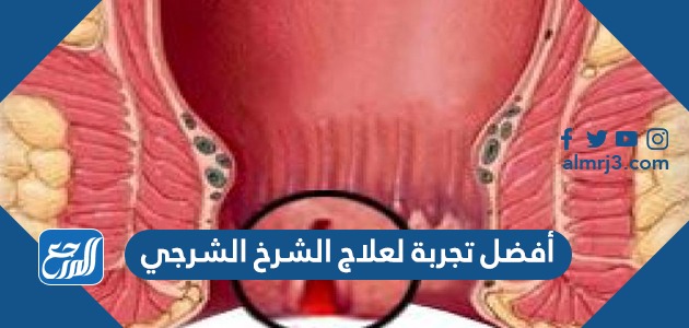 أفضل تجربة لعلاج الشرخ الشرجي