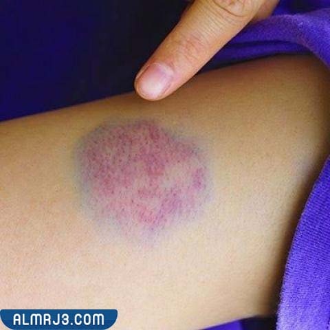 أنواع البقع الزرقاء في جسم المرأة
