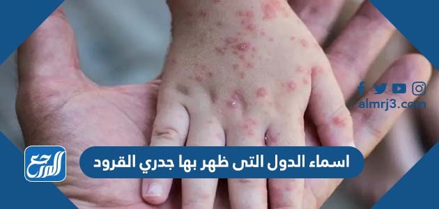 اسماء الدول التى ظهر بها جدري القرود