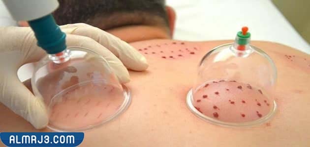 الأيام المكروهة لعمل الحجامة