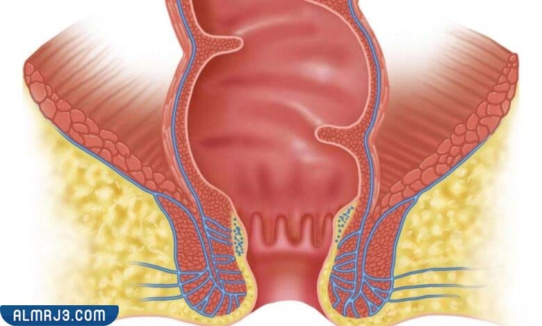الدرجة الأولى من مرض البواسير