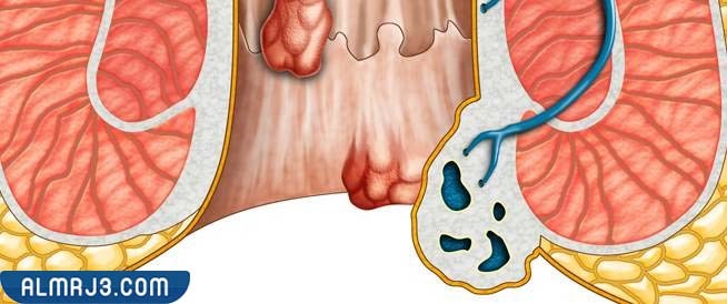 الدرجة الثالثة من مرض البواسير
