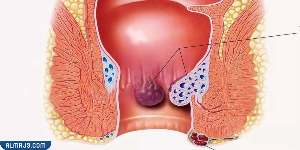 الدرجة الثانية من مرض البواسير