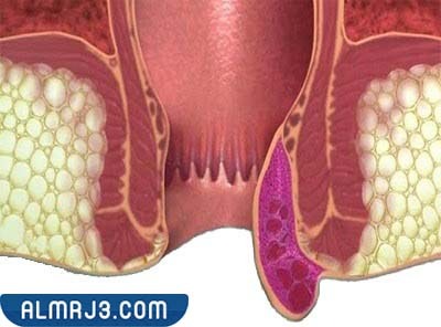 الدرجة الرابعة من مرض البواسير