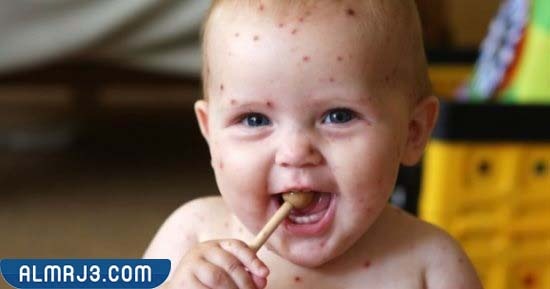 الفئات الأكثر إصابة بعدوى جدري القرود