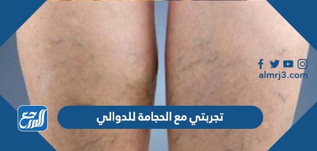 تجربتي مع الحجامة للدوالي