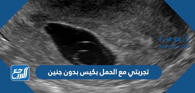 تجربتي مع الحمل بكيس بدون جنين