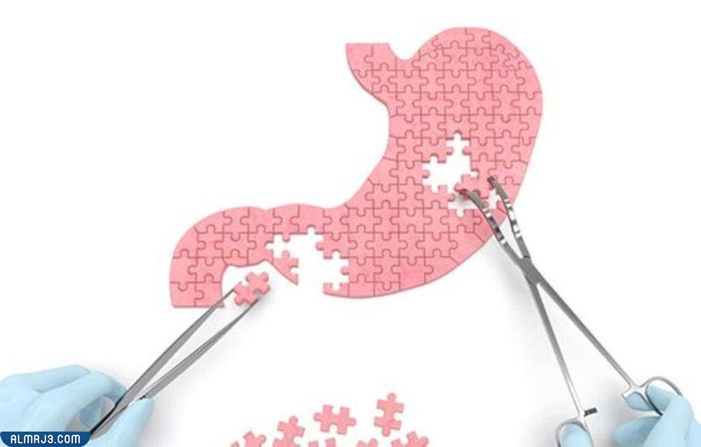 تجربتي مع تكميم المعدة