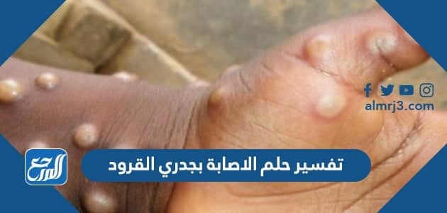 تفسير حلم الاصابة بجدري القرود