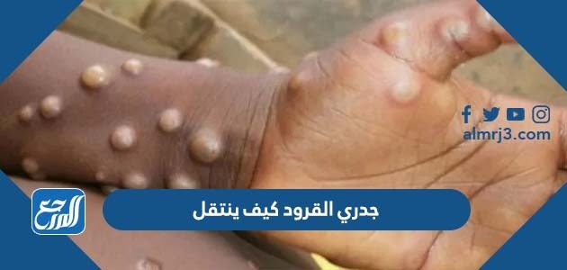 جدري القرود كيف ينتقل