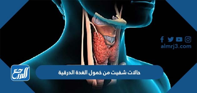 حالات شفيت من خمول الغدة الدرقية