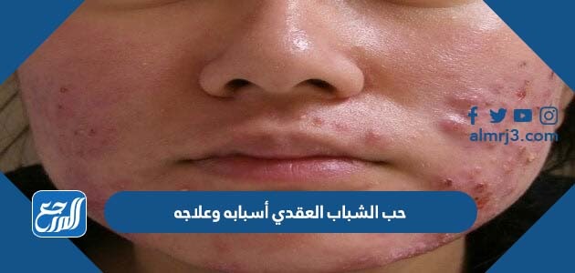 حب الشباب العقدي أسبابه وعلاجه