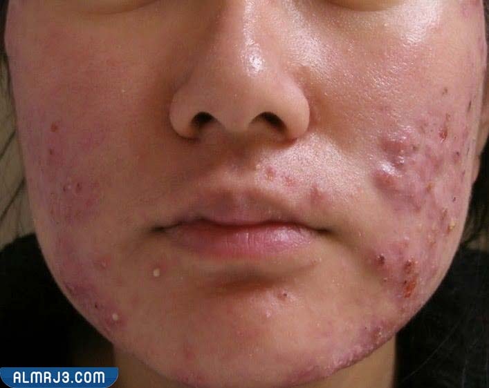 خصائص حب الشباب العقدي