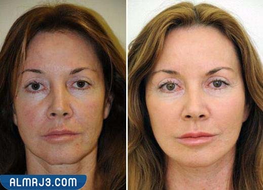 خلايا جذعية للبشرة قبل وبعد