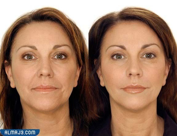 خلايا جذعية للبشرة قبل وبعد