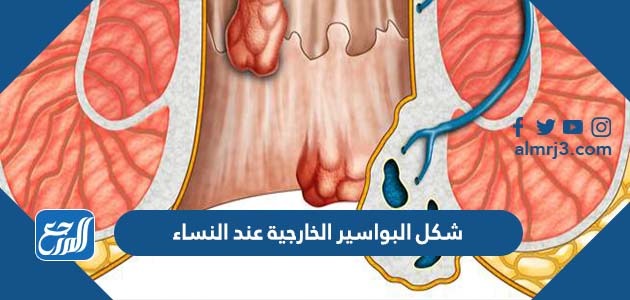 شكل البواسير الخارجية عند النساء
