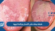 طبقة بيضاء على اللسان ورائحة كريهة