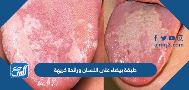طبقة بيضاء على اللسان ورائحة كريهة