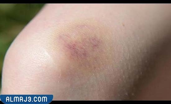 طرق الوقاية من البقع الورقاء عند النساء 