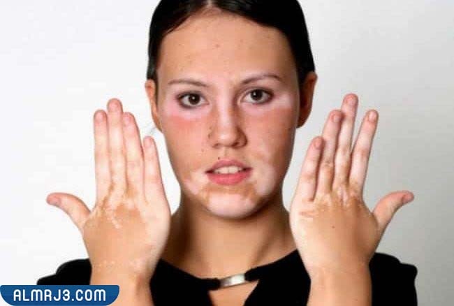 طرق علاج مرض البهاق