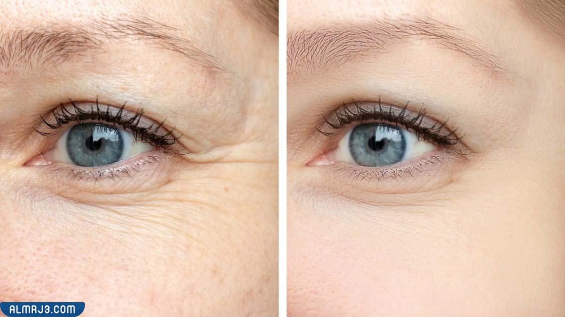 طريقة إستخدام الشبة للتخلص من التجاعيد