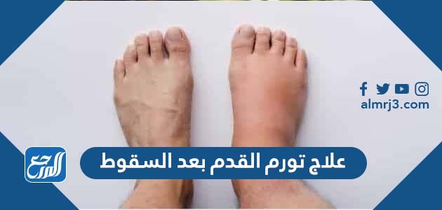 علاج تورم القدمين بعد السقوط