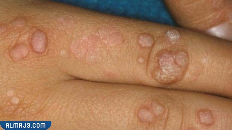 علامات الإصابة بجدري القرود