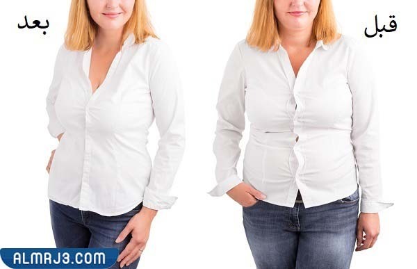 عملية تكميم المعدة قبل وبعد