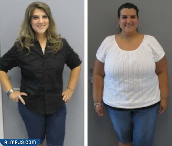 عملية تكميم المعدة قبل وبعد