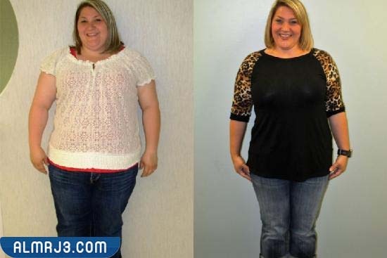 عملية تكميم المعدة قبل وبعد