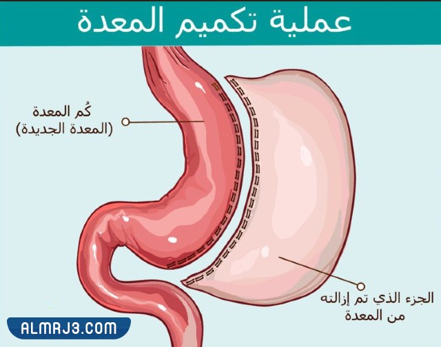 عملية تكميم المعدة