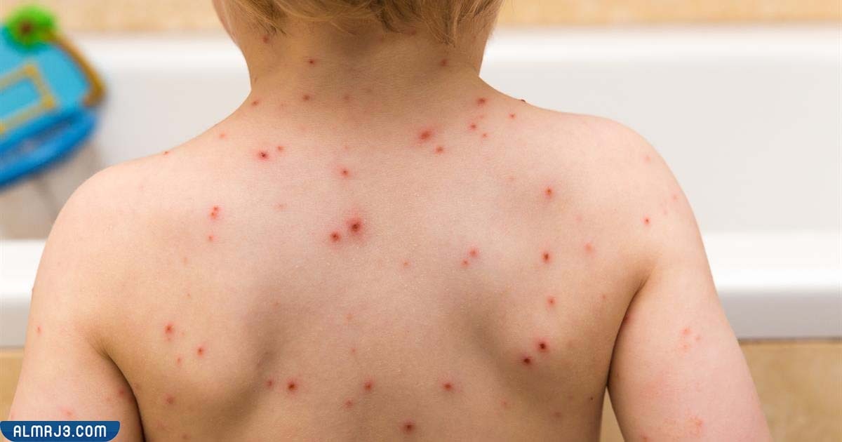 فترة عدوى مرض جدري القرود