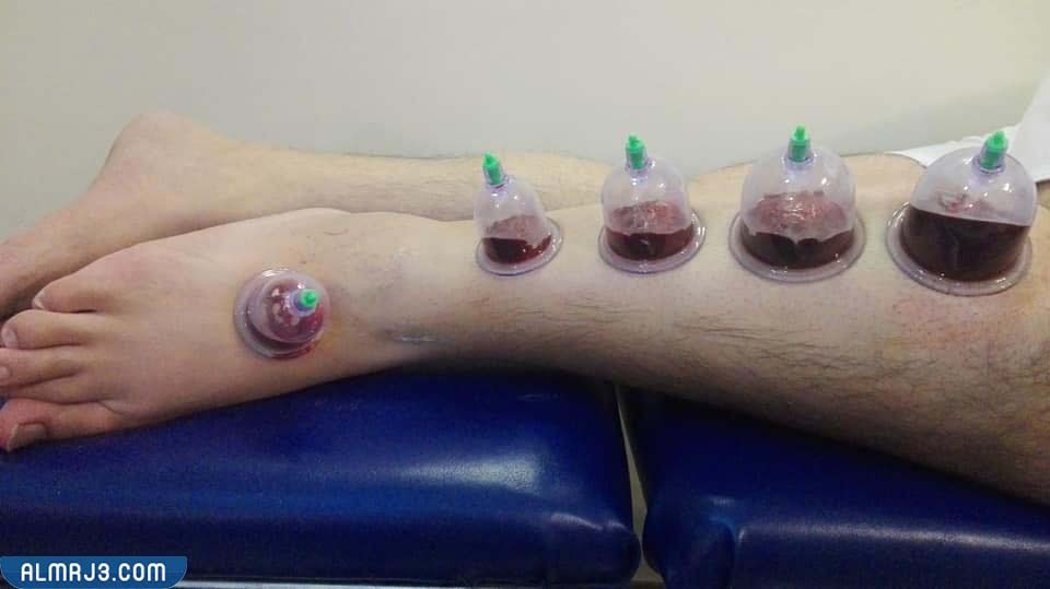 فوائد الحجامة لعلاج الدوالي