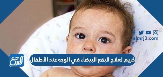 كريم لعلاج البقع البيضاء في الوجه عند الأطفال