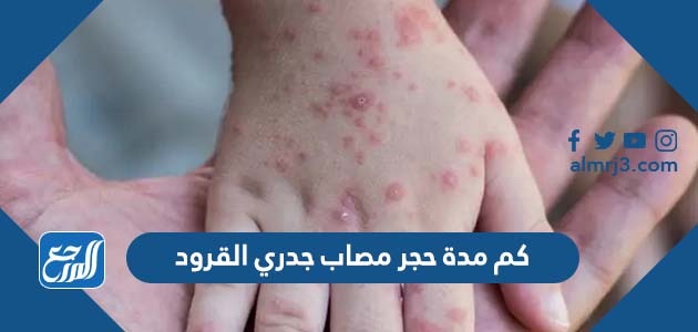 كم مدة حجر مصاب جدري القرود