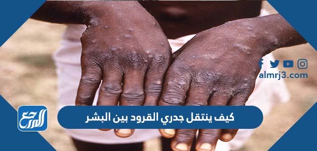 كيف ينتقل جدري القرود بين البشر