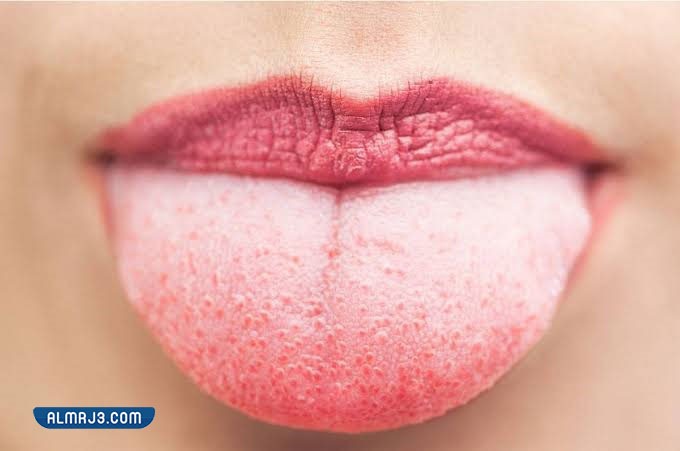 أسباب نمو طبقة بيضاء على اللسان تصاحبها رائحة كريهة