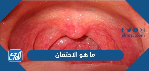 ما هو الاحتقان