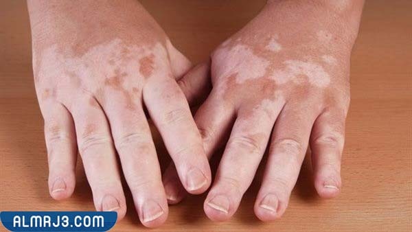 ما هو مرض البهاق