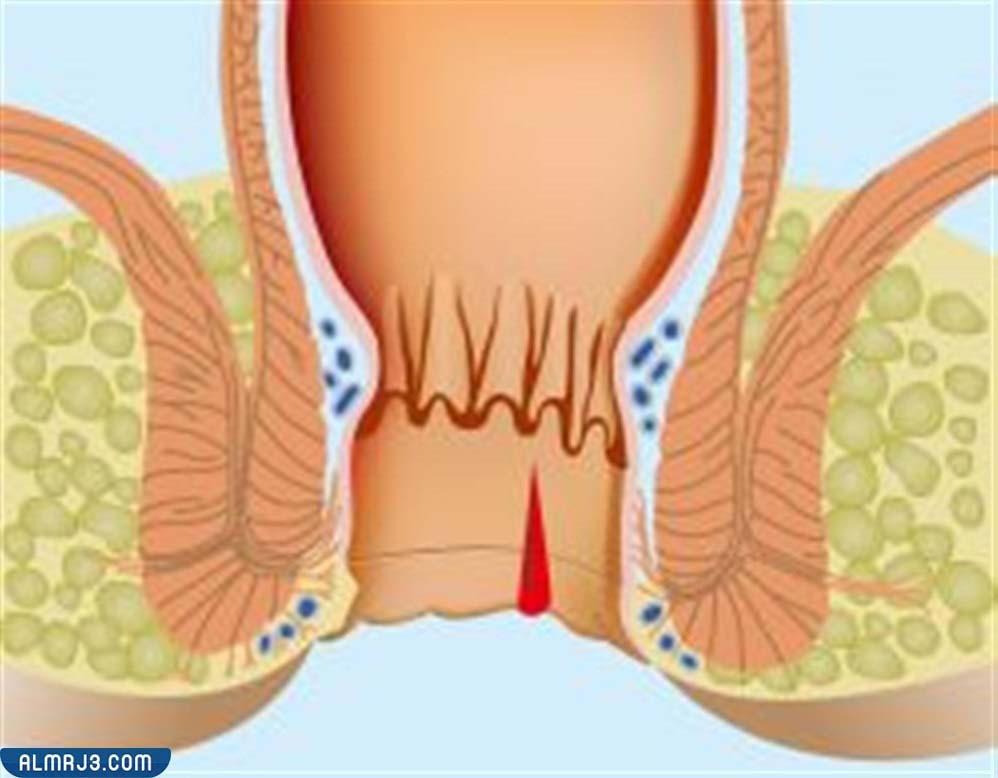 ما هو الشرخ الشرجي