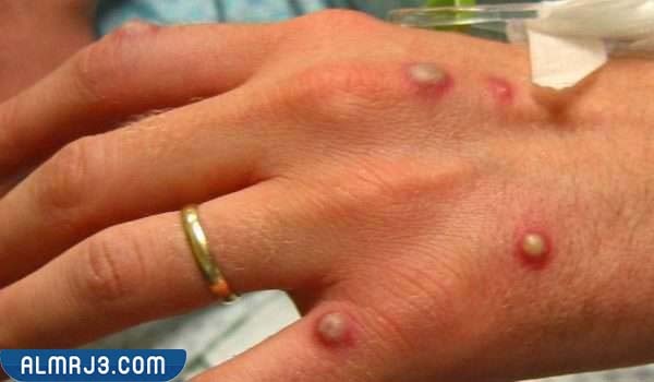 ما هو مرض جدري القرود