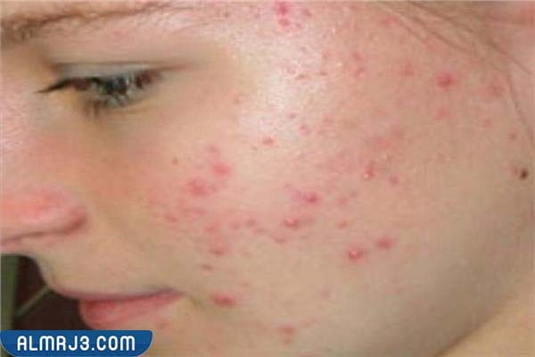 ما هو حب الشباب العقدي