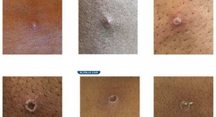 ما هي أعراض جدري القردة