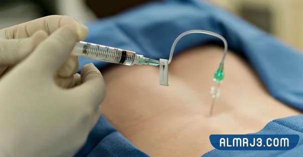 ما هي إبرة الظهر