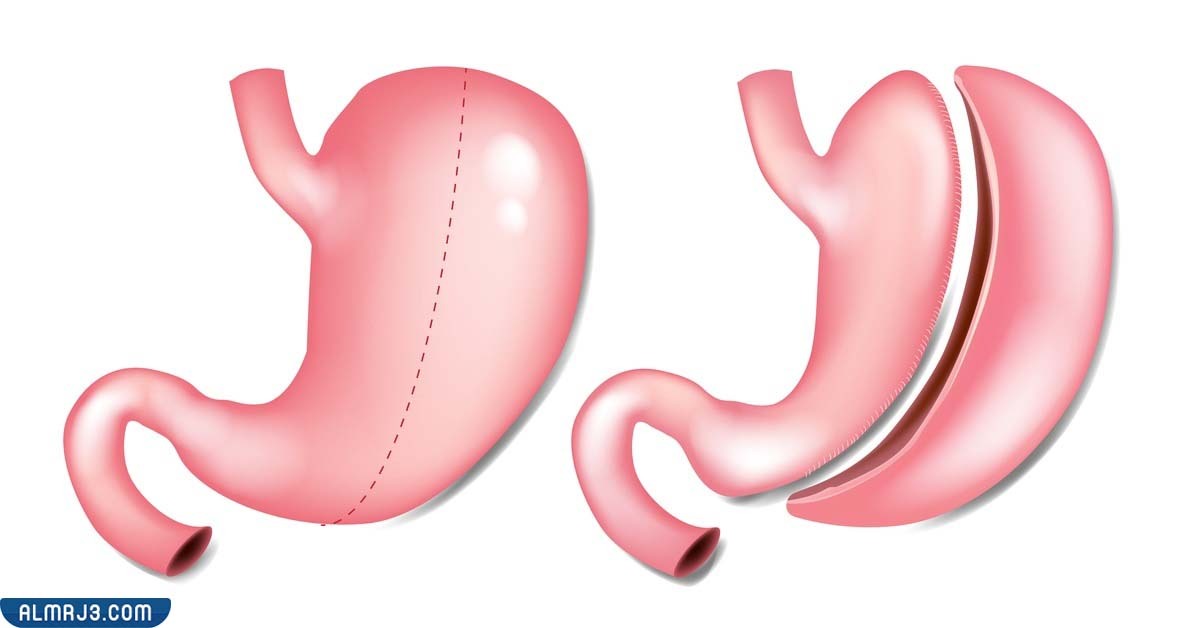 ما هي عملية تكميم المعدة
