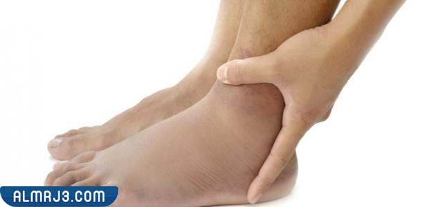 نصائح لتخفيف من حدة تورم القدمين بعد السقوط