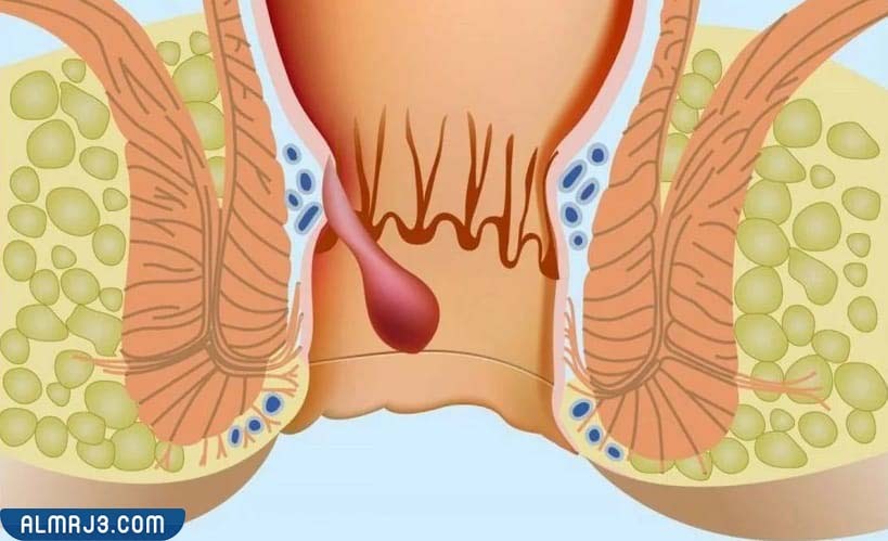 نصائح للوقاية من الشرخ الشرجي