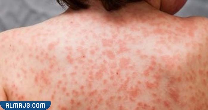 طرق الوقاية من الإصابة بجدري القرود